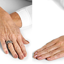 Inner_restylane_hands